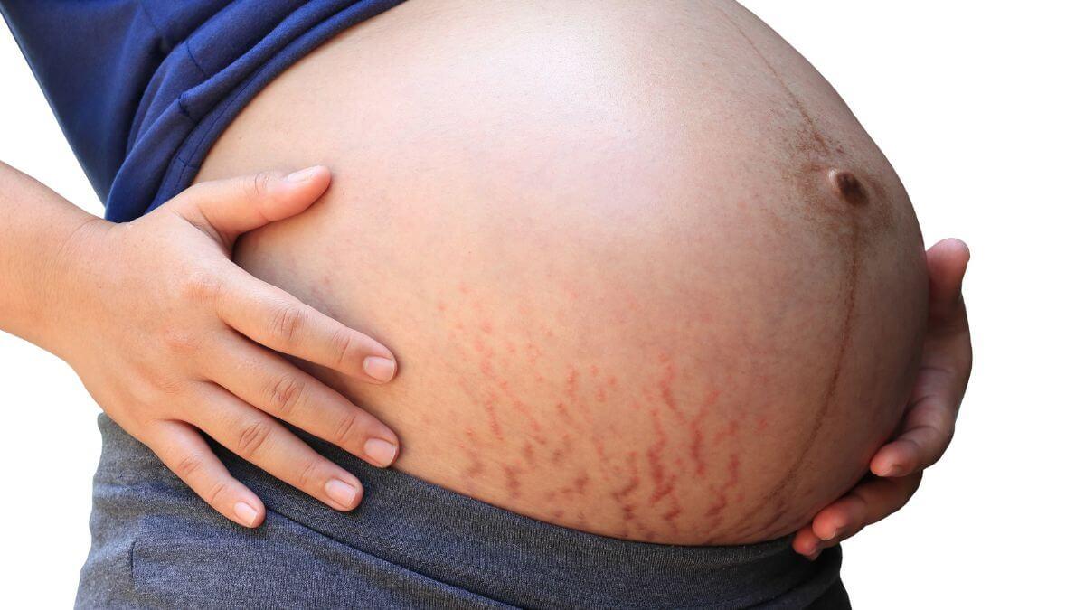 PUPPP Skin Rash During Pregnancy: Symptoms, Causes, 54% OFF