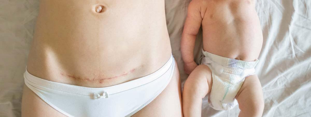 All You Need to Know About Your C-Section Scar
