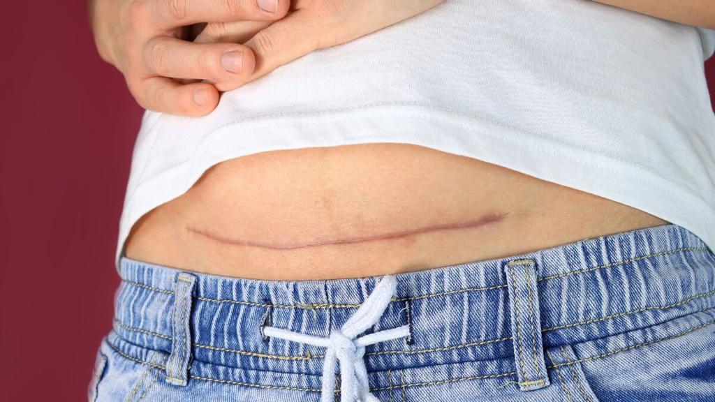 What To Know About Menopause After A Hysterectomy Peanut What To Know About Menopause After A Hysterectomy Peanut