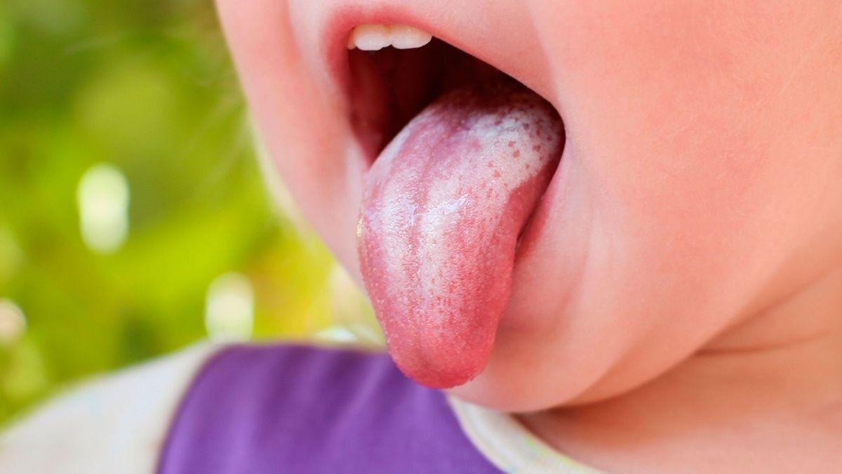 Thrush in Babies: All The Key Info | Peanut