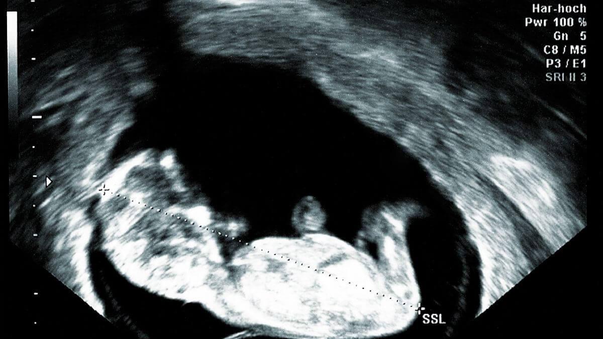 12 week ultrasound down syndrome pictures