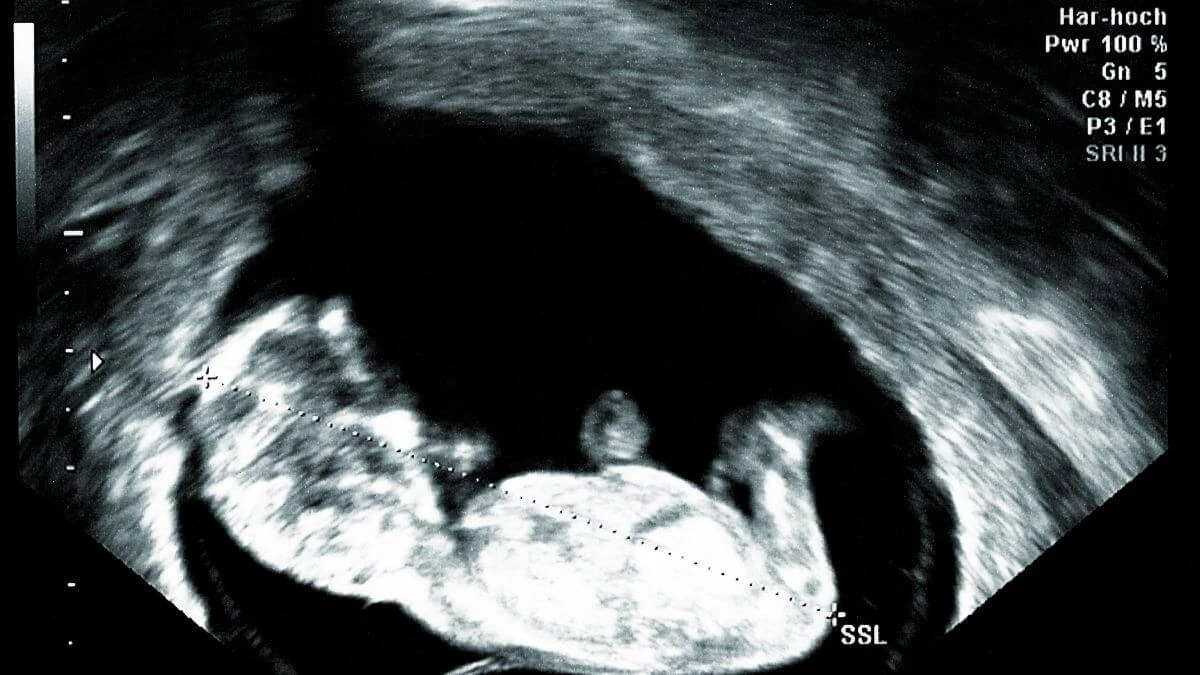 12 week ultrasound