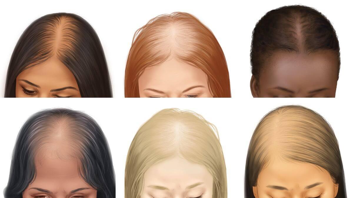 What to Know About Hair Loss During Pregnancy | Peanut What to Know About Hair Loss During Pregnancy | Peanut