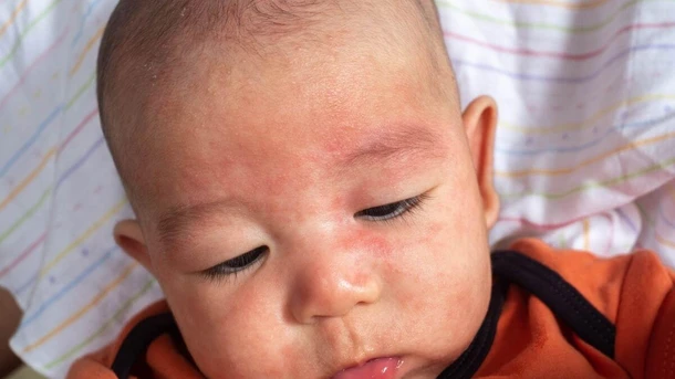 Baby Rash