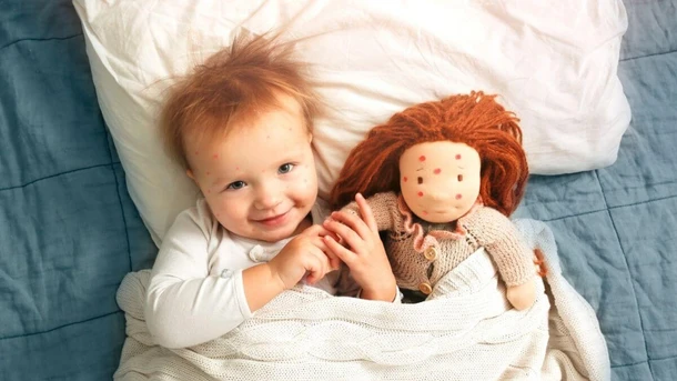 Chickenpox on Babies