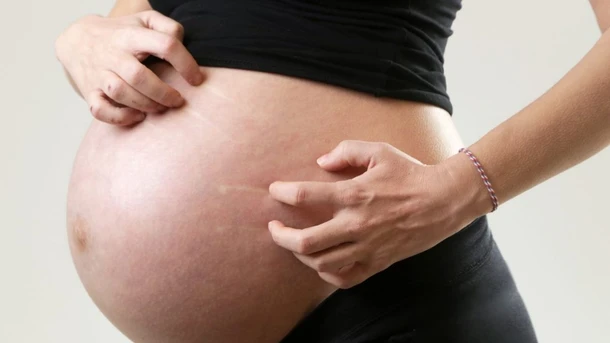 cholestasis of pregnancy