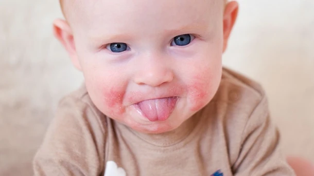 Teething Rash