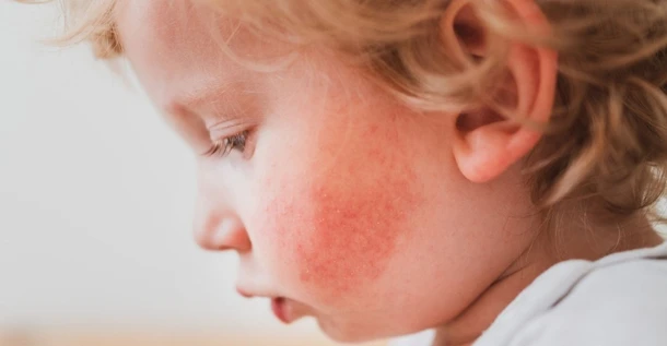 Baby Allergies