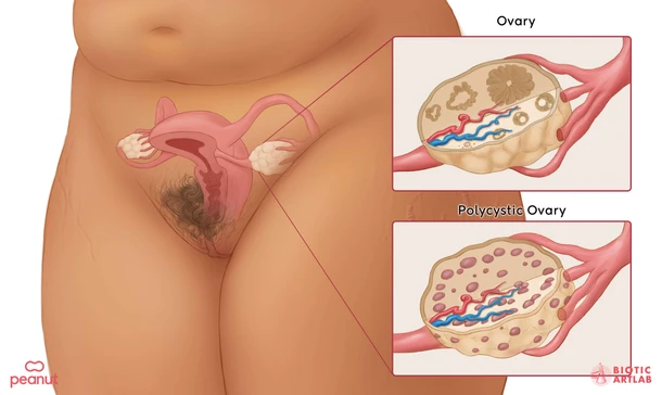 What is PCOS?
