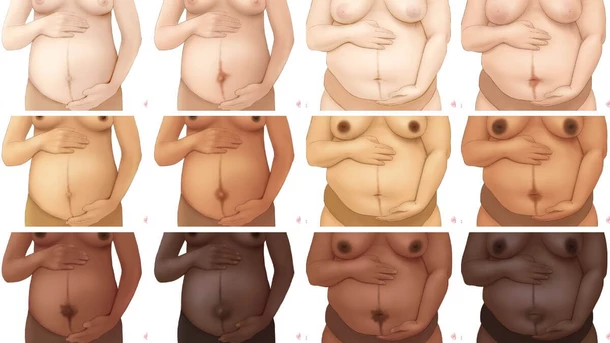 Linea nigra on different skin tones and body types