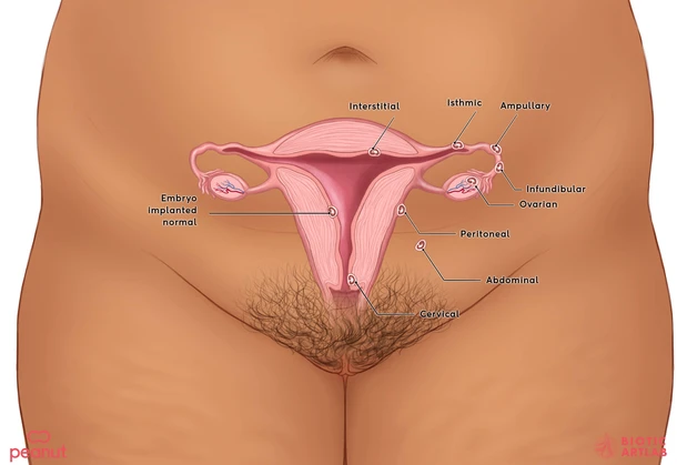 Ectopic pregnancy