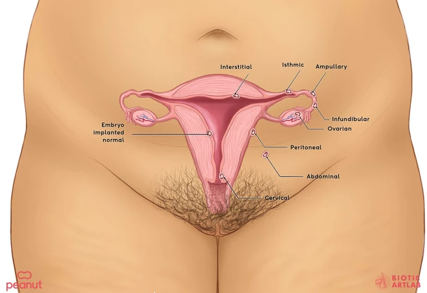 Ectopic pregnancy