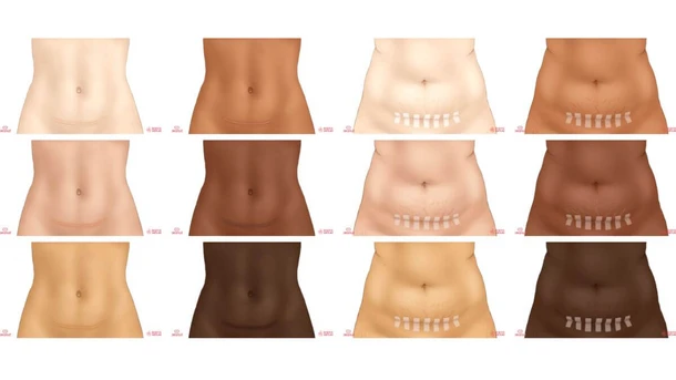 Horizontal c-section scar on different body types and skin tones