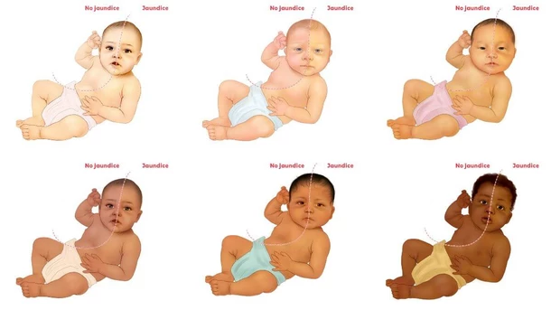 Newborn jaundice on different skin tones