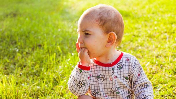 Ringworm in Babies