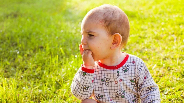 Ringworm in Babies
