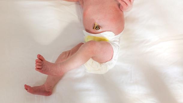 Baby’s Umbilical Cord Falling Off 