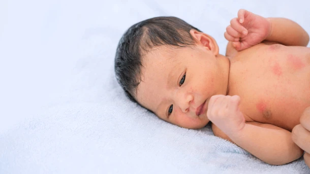 Hives on Baby