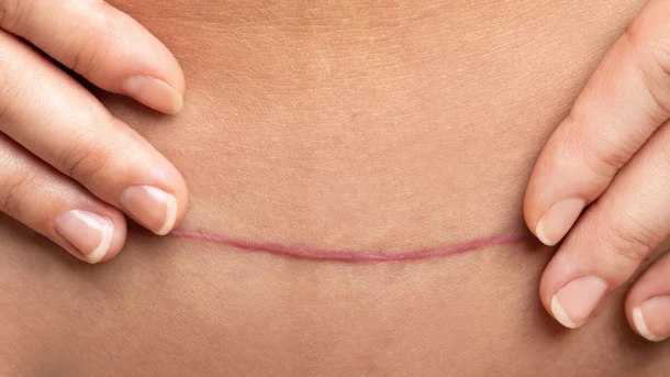 Transverse C-Section Scar