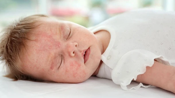 Angel’s Kiss Birthmark