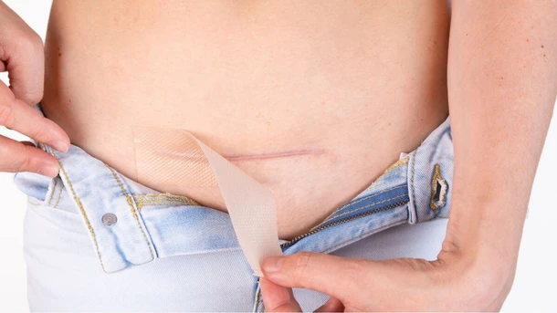 C-Section Recovery Tips