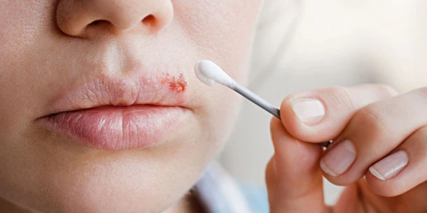 Cold Sore While Pregnant