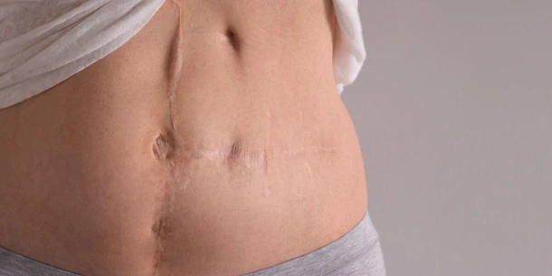 What is a Hysterectomy?