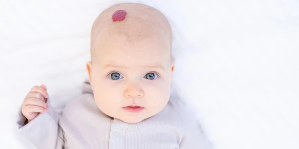 What is a Hemangioma? Causes, Types & Treatment