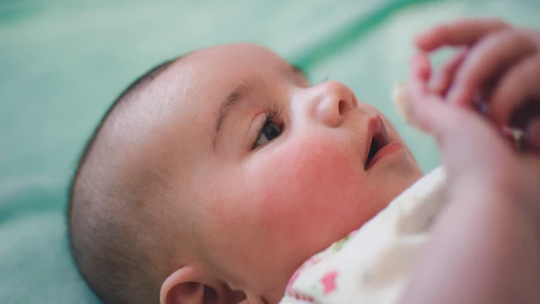 Baby acne