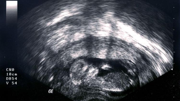 Your 12-Week Ultrasound: to Expect Peanut