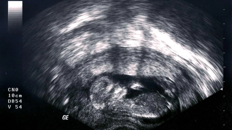 21 weeks pregnant ultrasound face