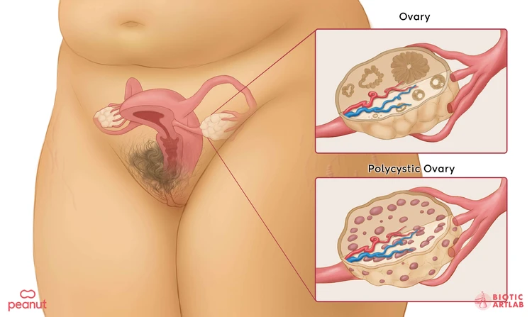 What is PCOS?