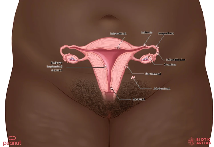 Ectopic pregnancy