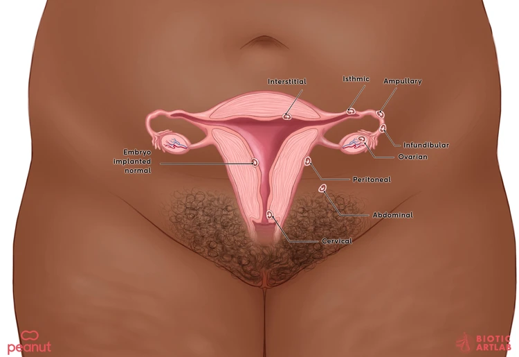 Ectopic pregnancy