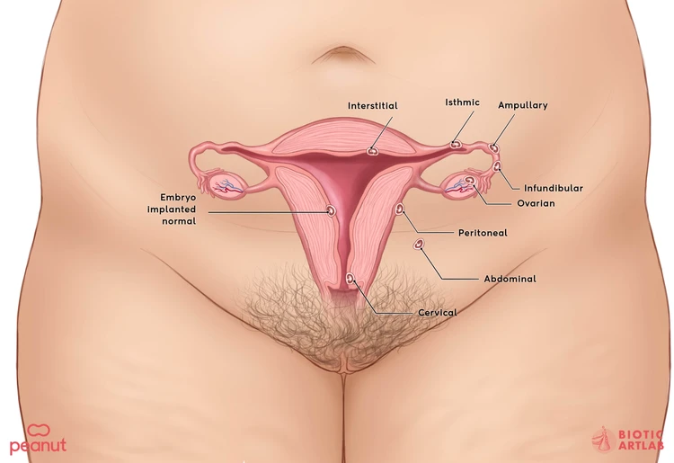 Ectopic pregnancy