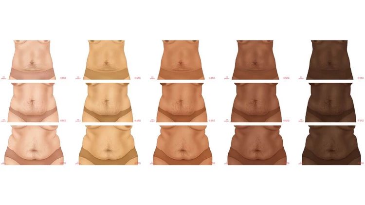 Postpartum body on different skin tones and body types