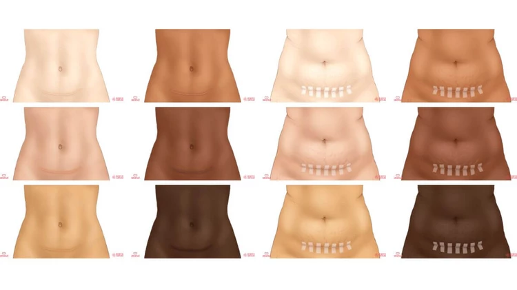 Horizontal c-section scar on different body types and skin tones