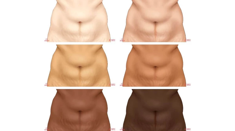 types of Vertical c-section scars on different skin tones