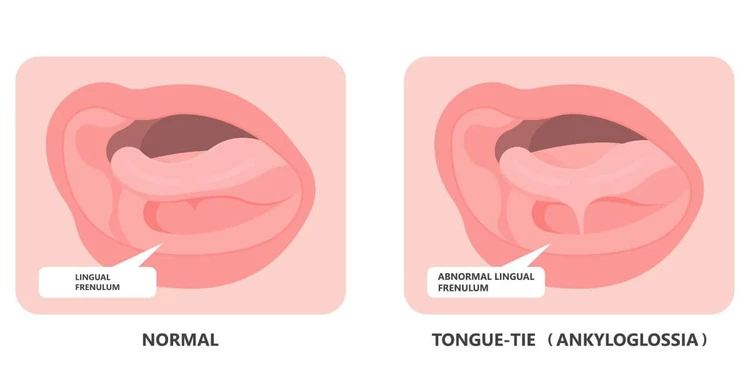 Tongue-tie in babies