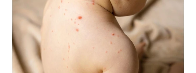 Baby Rash or Eczema? The Ultimate Guide to Baby Rashes