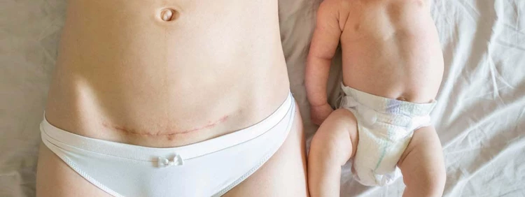 Everything You Need to Know About Your C-Section Scar