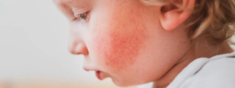 Baby Red Cheeks: What to Know