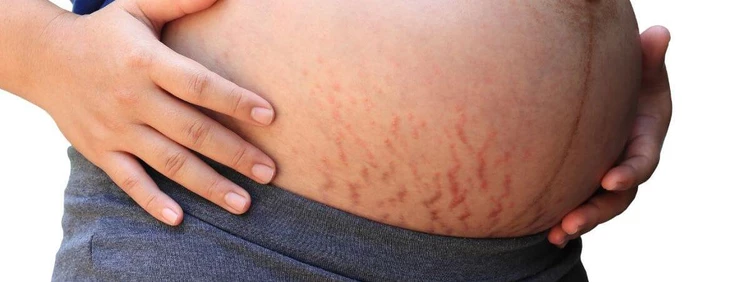What to Know About PUPPP Rash