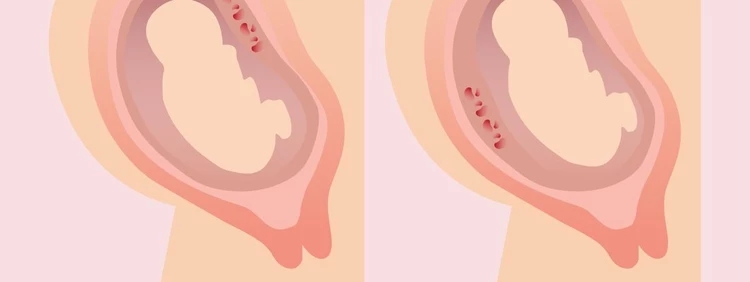 ¿Qué es un fondo de placenta o placenta fúndica?