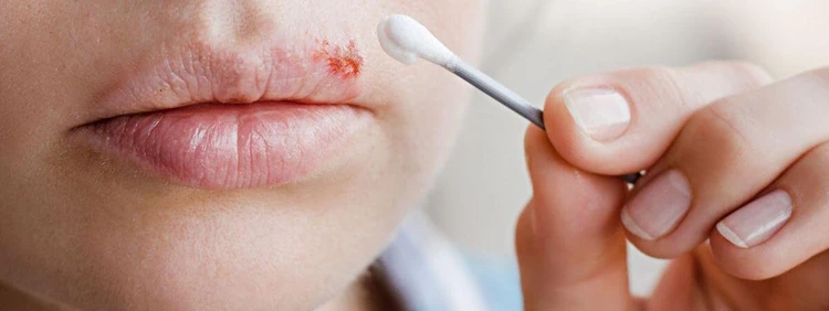 Cold Sore While Pregnant: What to Know