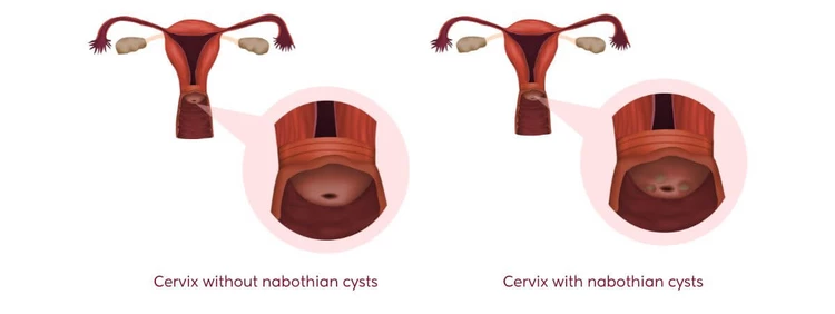 Nabothian cysts pictures, showing a cervix without nabothian cysts and a cervix with nabothian cysts