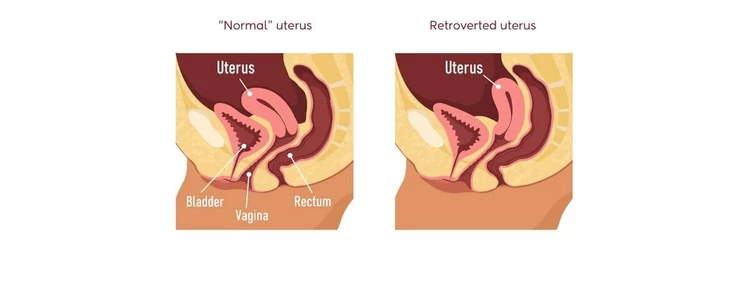Normal vs retroverted uterus pictures comparison