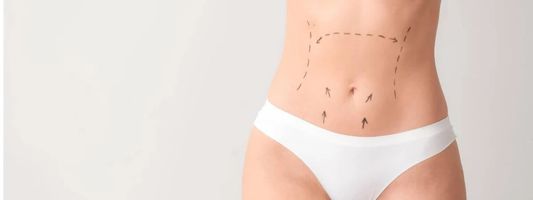 Can You Get Pregnant After a Tummy Tuck?