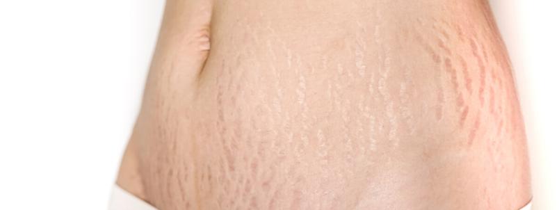 stretch-marks-belly