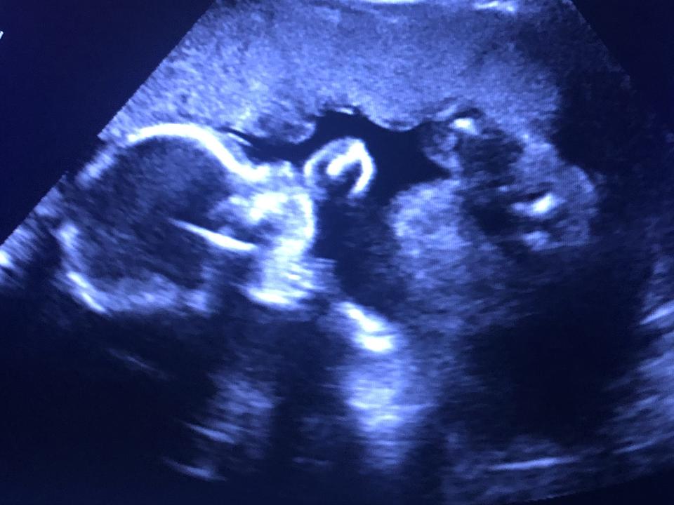 Baby Crowning What Is It & What Does It Feel Like? Peanut